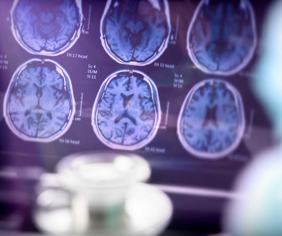 Brain Scans used in Alzheimer's Research for new drug treatments.